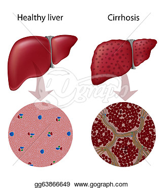 Eps Illustration   Liver Disease Cirrhosis Eps10  Vector Clipart