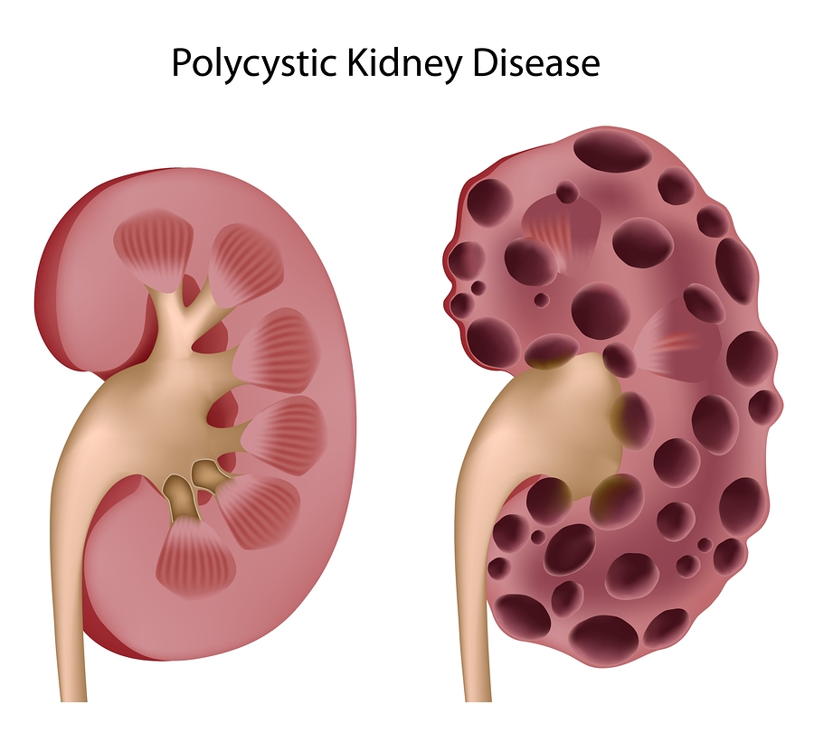 Kidney Pain   Causes Locationsymptoms And Treatment