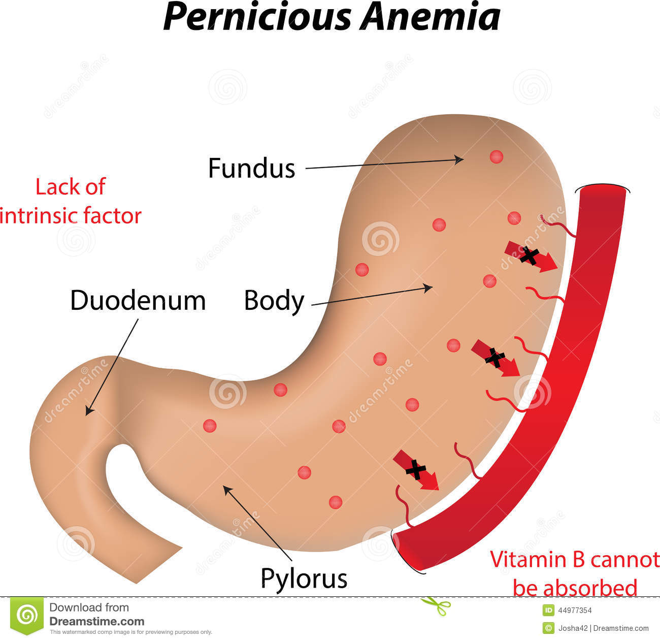 Pernicious Anemia The Vitamin B 12 Deficiency Disease