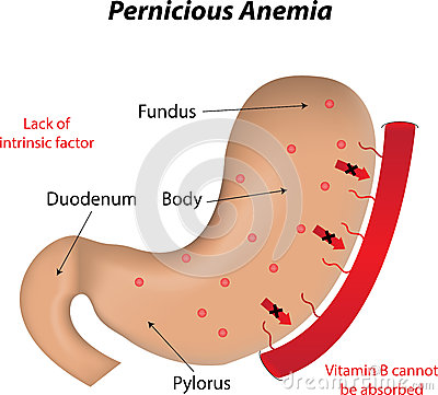 Pernicious Anemia The Vitamin B 12 Deficiency Disease 