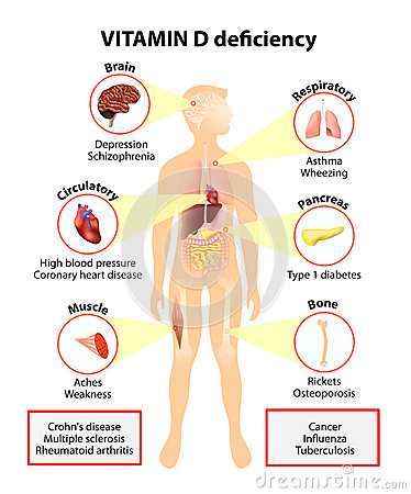 Vitamin D Deficiency  Symptoms And Diseases Caused By Insufficient