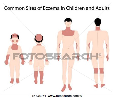Clipart   Sites Of Eczema  Fotosearch   Search Clip Art Illustration