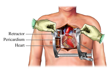 Open Heart Surgery   Procedure And Recovery   Health Dictionary