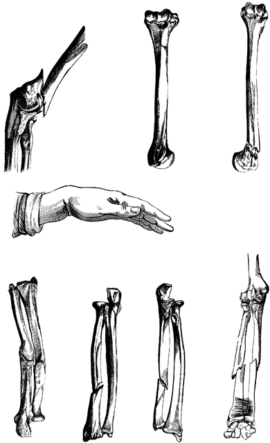 Types Of Broken Bones   Clipart Etc