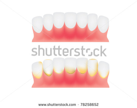 Vector Of Teeth And Gums Dental Plaque   Two Type Difference Of Teeth    