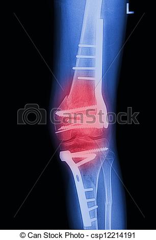 Image Broken Knee Joint With Implant Image X Rays Painful Of Knee