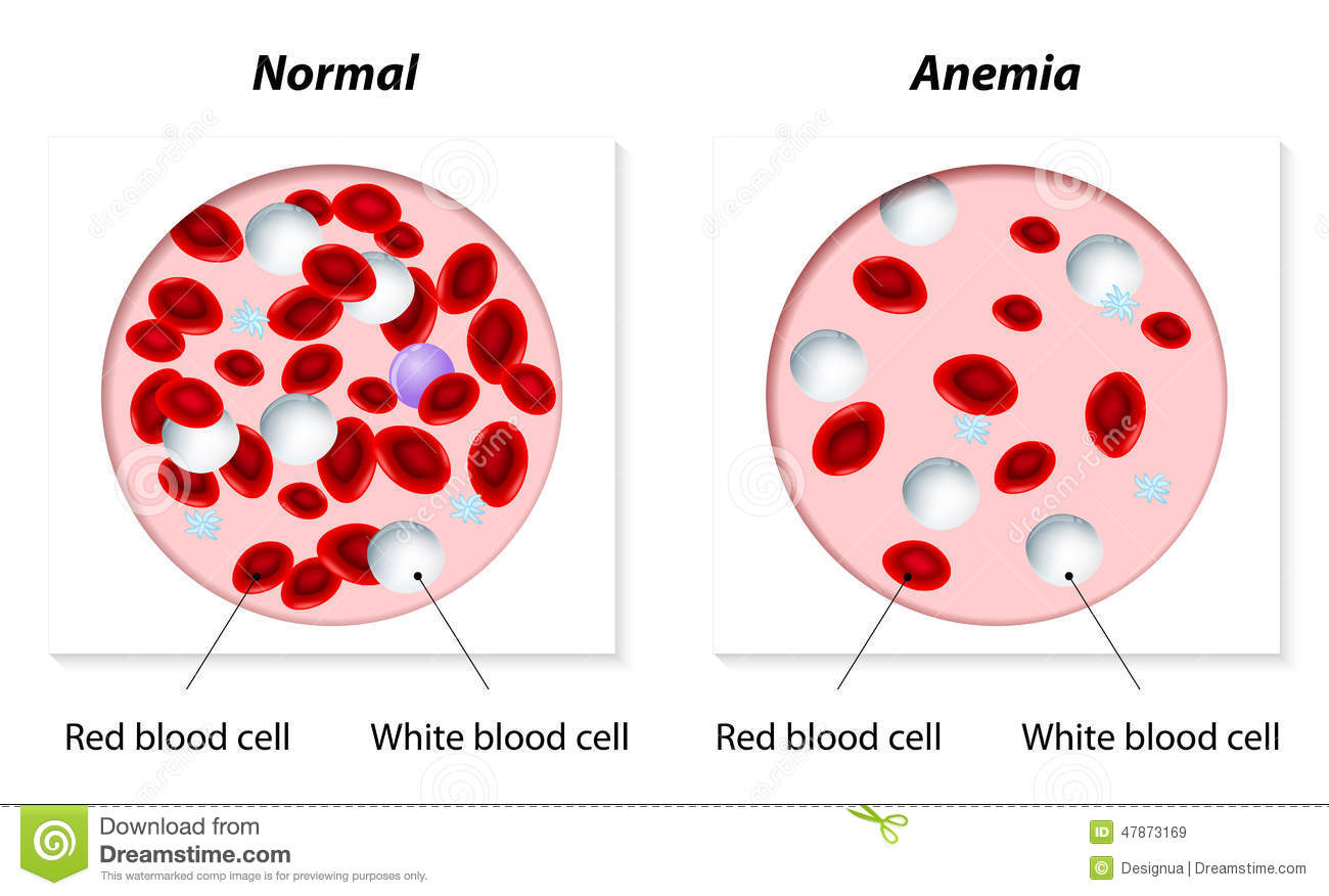 Anemia Normal Anemic Amount Red Blood Cells Vector Illustration