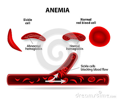 Anemia  Sickle Cell And Normal Red Blood Cell