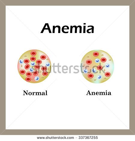 Anemia  The Reduced Amount Of Red Blood Cells  Infographics  Vector