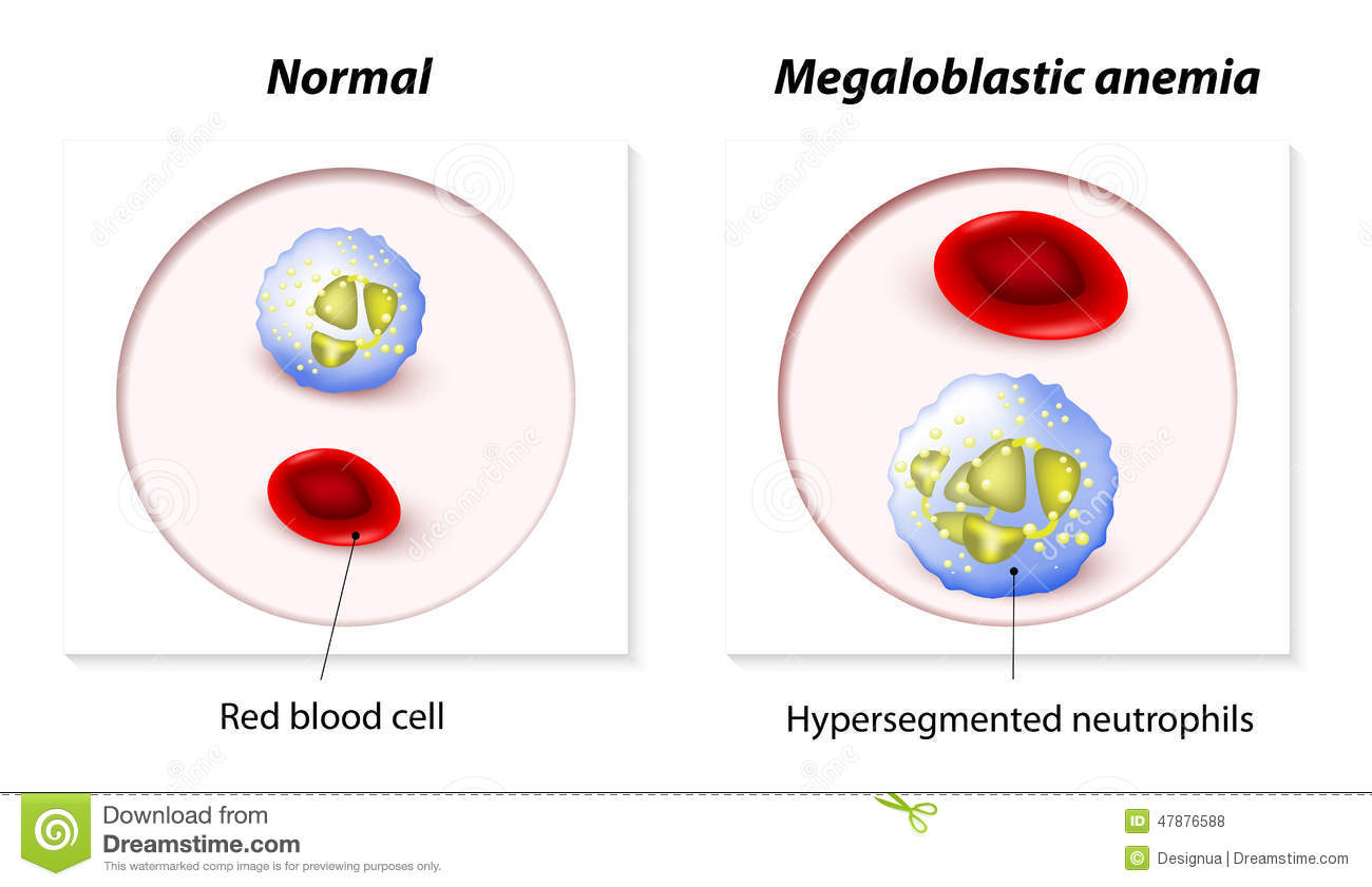 Megaloblastic Anemia  Red And White Blood Cells Are Too Large