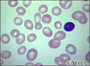 Red Blood Cells  Rbcs  That Are Seen In Megaloblastic Anemia