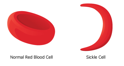 Sickle Cell 1 Jpg