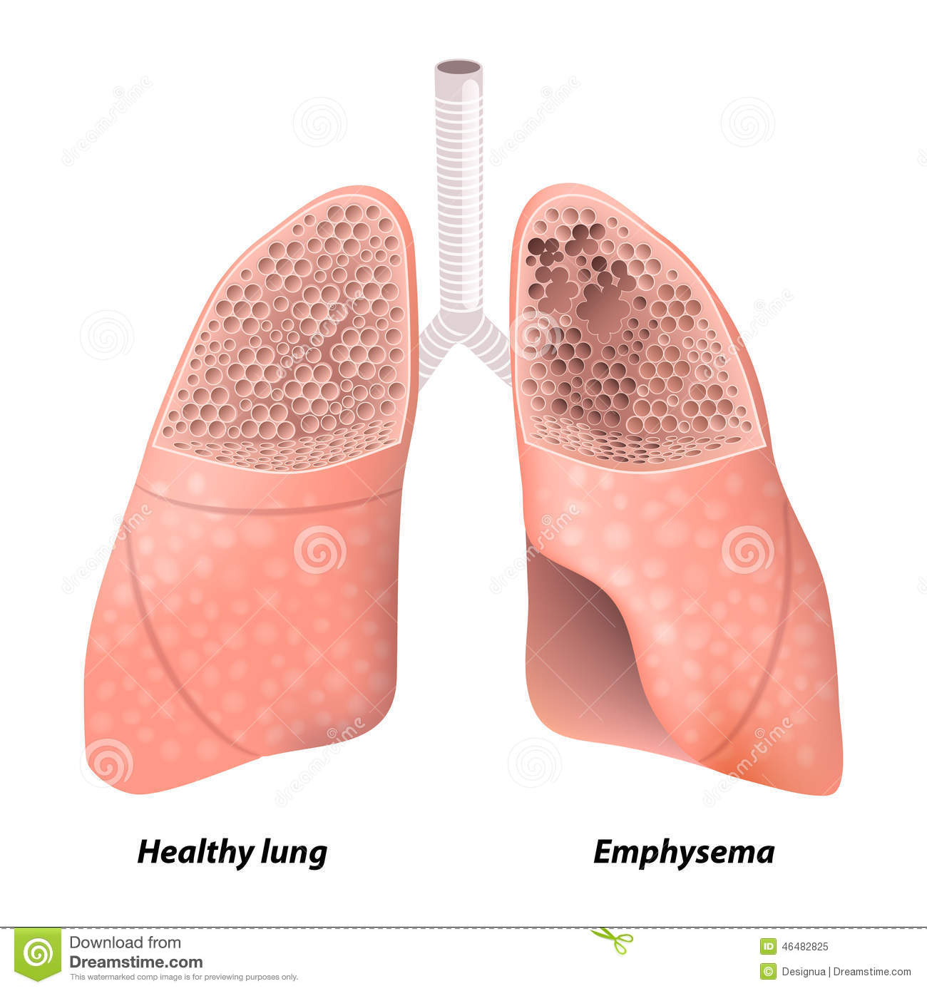 Chronic Obstructive Pulmonary Disease Stock Vector   Image  46482825