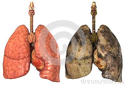 Copd Cartoons Copd Pictures Illustrations And Vector Stock Images