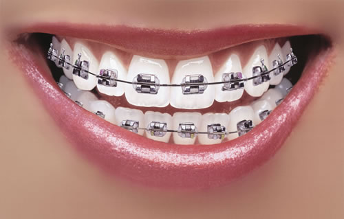 Veneers Braces And Invisalign  Which Teeth Straightening Method Is