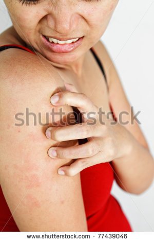 Itchy Skin Clipart   Itchy Skin Stock Photos Images   Pictures    