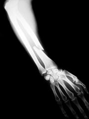 Broken Forearm Is Usually A Fracture To The Radius Bone Although    