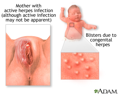 Infants May Get Congenital Herpes From A Mother With An Active Herpes    