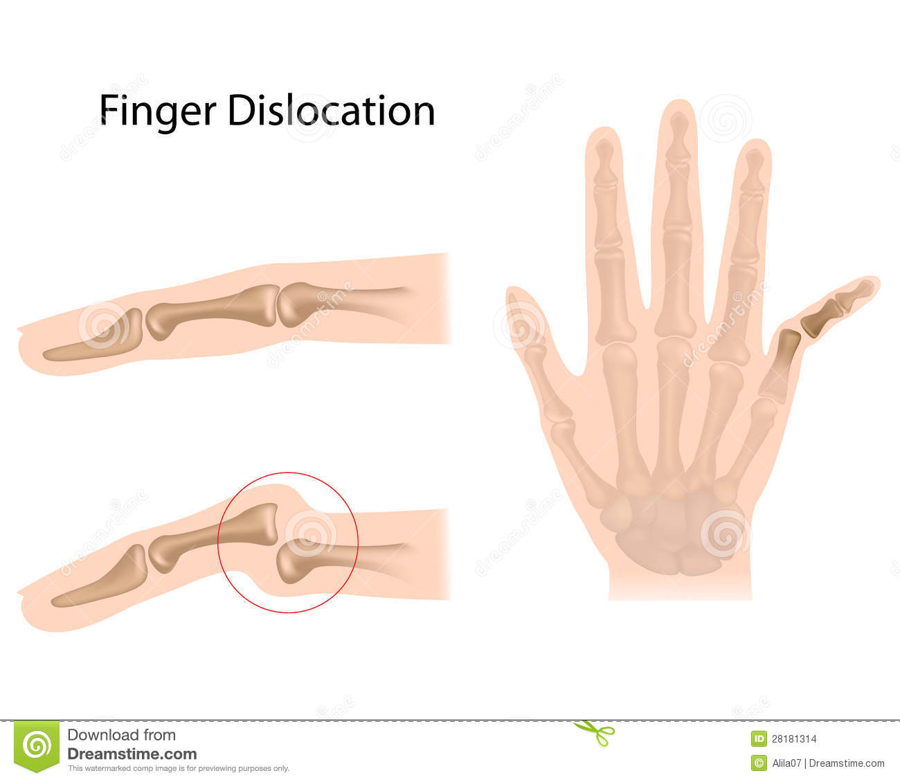 Dislocation Of Bones At Different Finger Joints Eps10