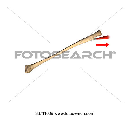 Illustration Of Avulsion Fracture  3d711009   Search Vector Clipart