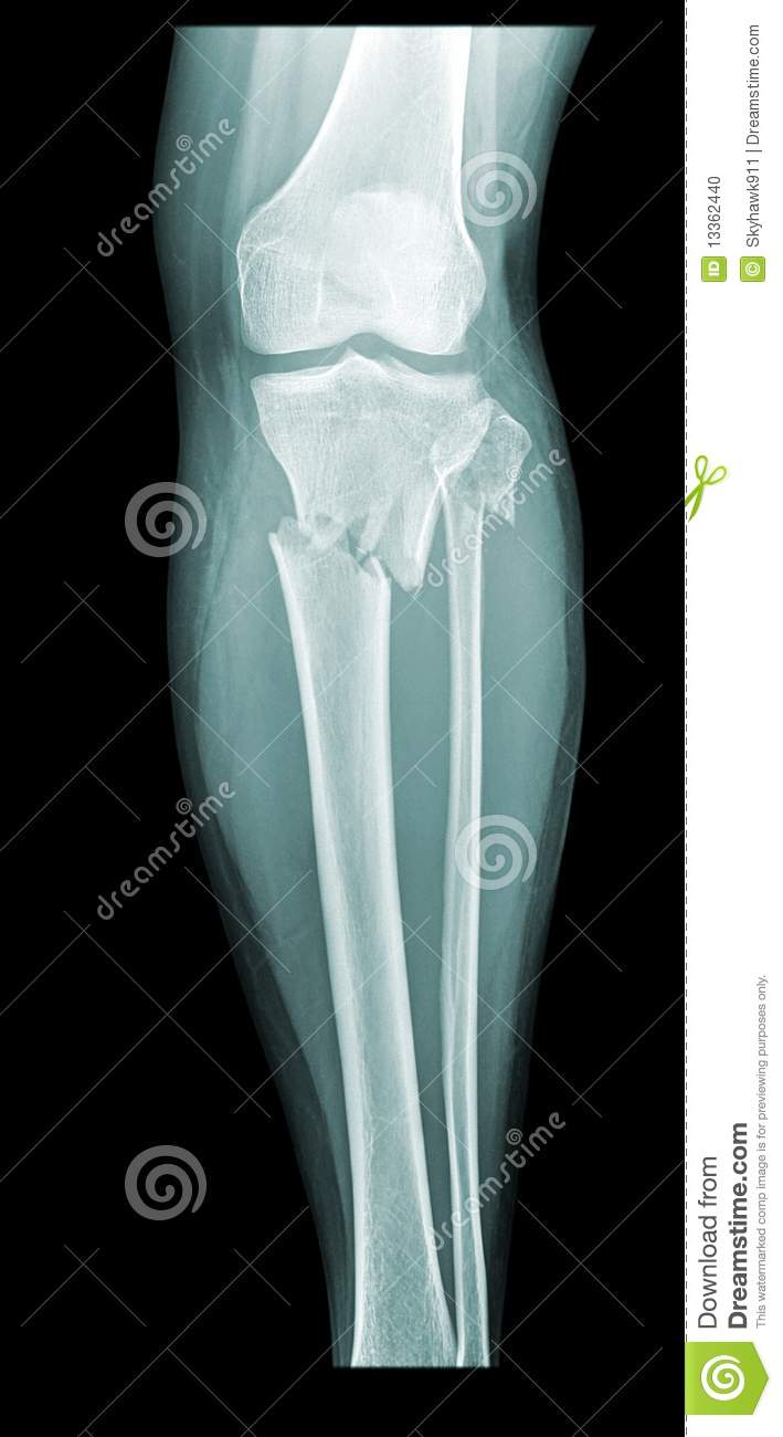 Lower Leg Fracture Of The Tibia And Fibula With Little Dislocation