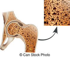 Osteoporosis In Femur Bone Human Bone Anatomy  Clip Art Vector