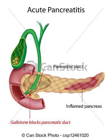 Pancreas Caused By    Csp12461020   Search Clipart Illustration