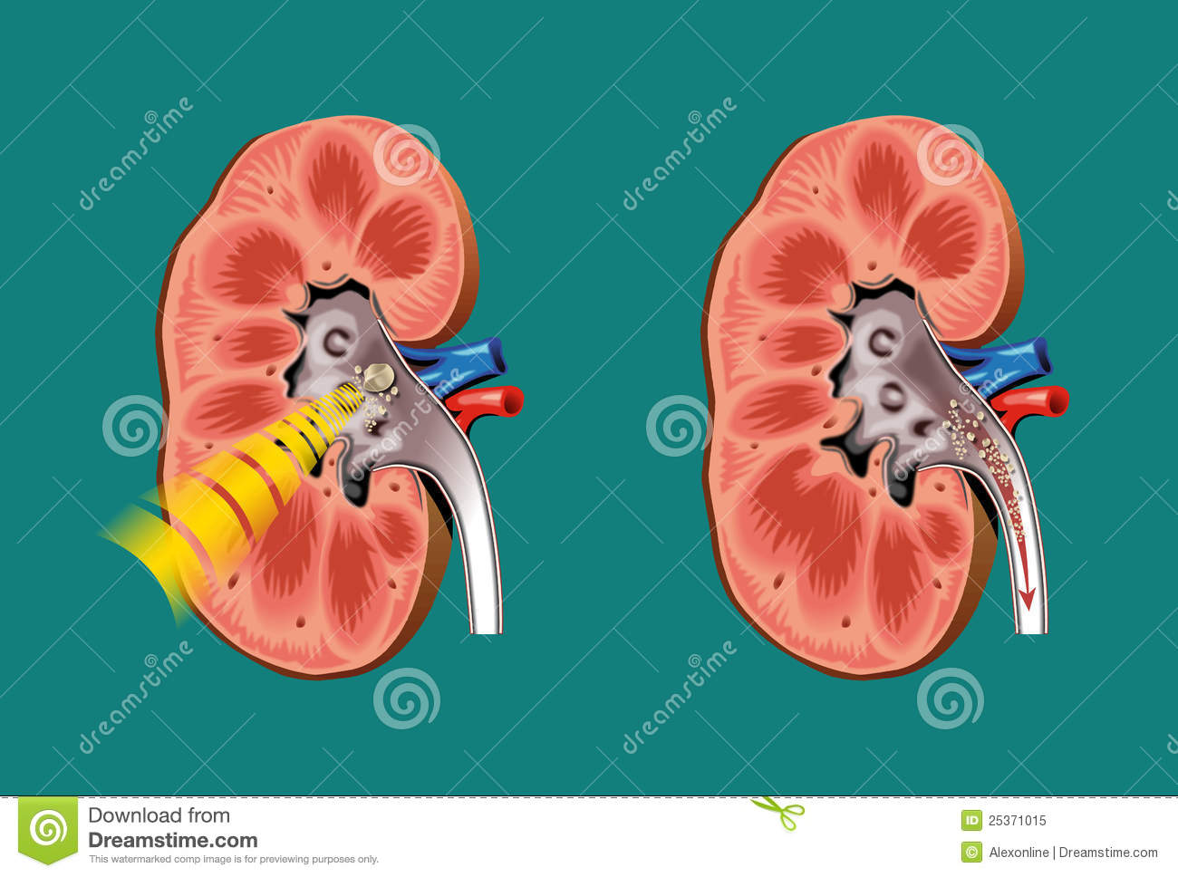 Kidney Dialysis Clipart