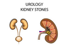 Kidney Transplant Stock Vectors Illustrations   Clipart