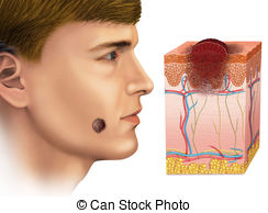 Skin Cancer Illustrations And Clipart
