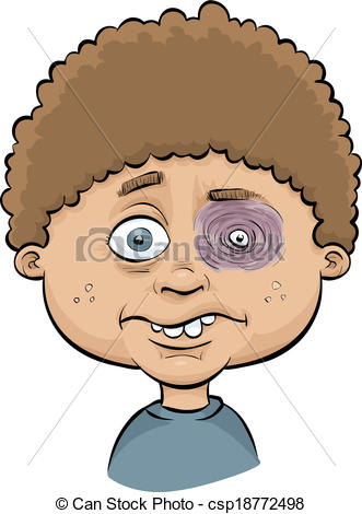 Vectors Of Boy With Black Eye   A Cartoon Boy With A Painful Swollen