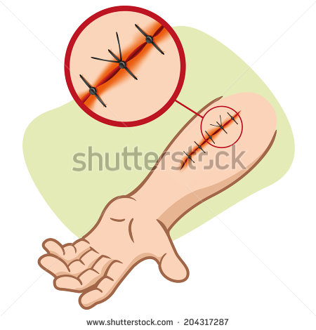 Suture Injury   Illustration Of A Receiving First Aid Injury Or Cut
