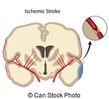 Brain Ischemic Stroke Eps10   Cross Section Of The Brain
