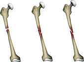 Bone Health Illustrations And Clipart