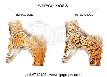 Osteoporosis May Leads To Bone Fracture   Clipart Gg64712123