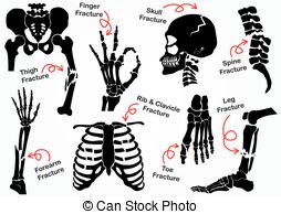 Set Bone Fracture Icon   Pelvic  Hip  Thigh   Femur    Hand  Wrist