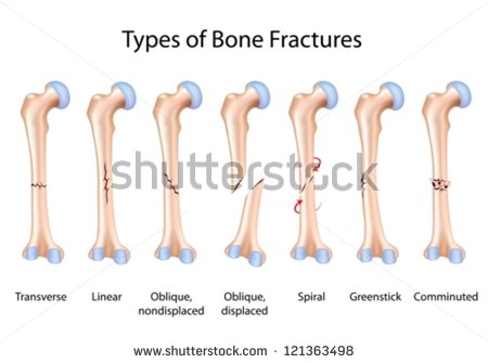 Types Of Bone Fractures   Stock Vector