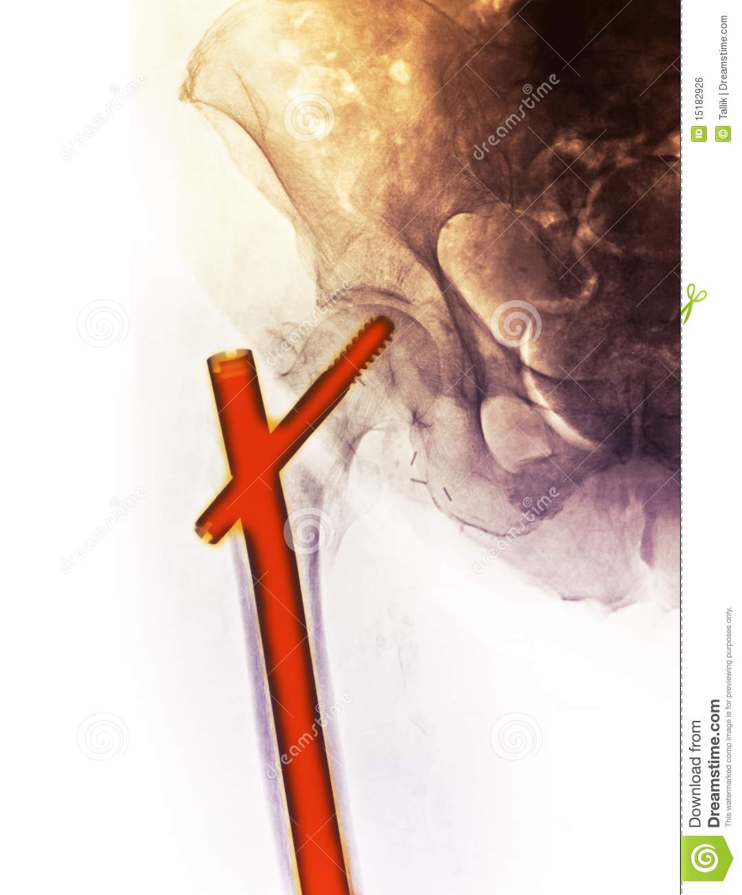 Hip X Ray Showing A Fracture Royalty Free Stock Image   Image