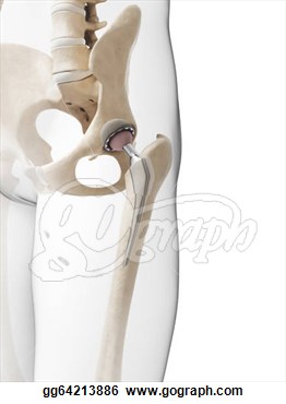 Rendered Illustration Of A Hip Replacement  Stock Clipart Gg64213886