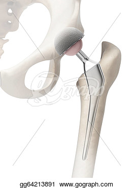 Rendered Illustration Of A Hip Replacement  Stock Clipart Gg64213891