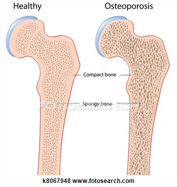 Stock Illustration Of Osteoporosis Of Hip Bone Eps8 K8067948   Search