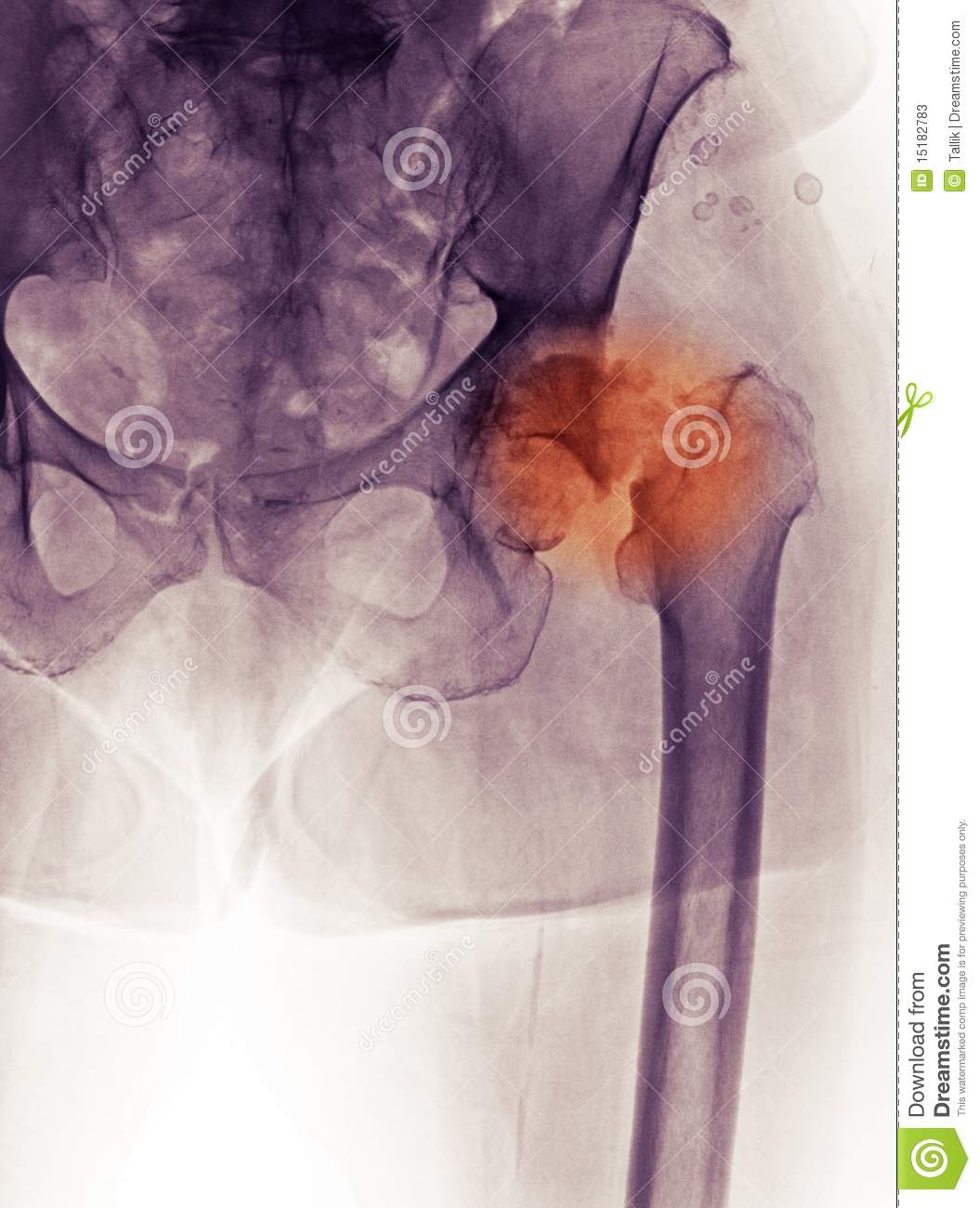 Stock Photos  Hip X Ray Fracture And Djd  Degenerative Joint D