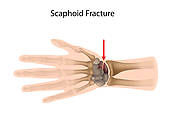 Wrist Fracture Eps10 Hydraulic Fracturing Icon Femoral Neck Fracture