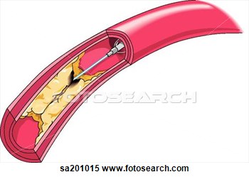 Blood Vessel Utilizing A Clot Buster   Fotosearch   Search Clipart    