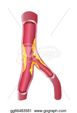       Cholesterol In Blood Vessel Walls  Clipart Drawing Gg66483581