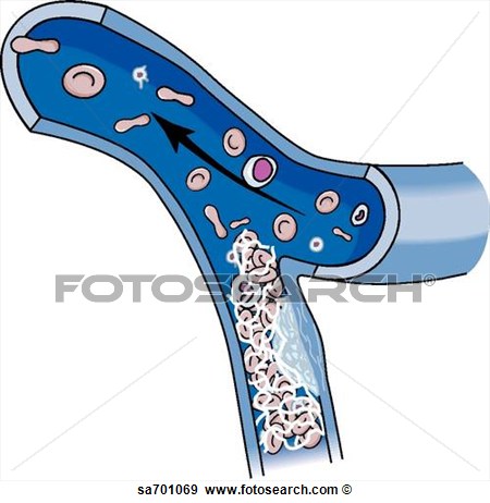 Of A Thrombus Within A Blood Vessel  Sa701069   Search Vector Clipart