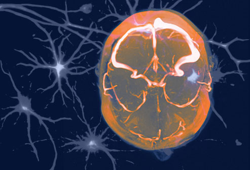 Migraine Headaches Brain What Causes A Migraine