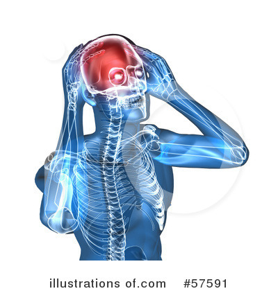 Migraine Headaches Clip Art  Rf  Migraine Clipart