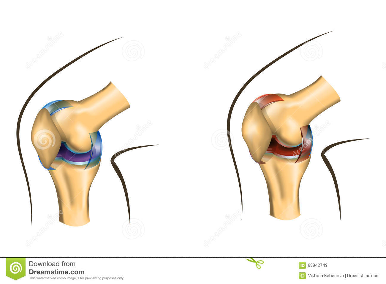 The Knee Joint Of Healthy And Damaged Stock Vector   Image  63842749