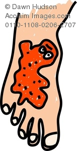 Infection Clipart 0110 1108 0206 2707 Germ Infection On A Human Foot    